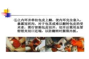 昌吉切包皮哪家最好(昌吉男科去哪家医院看比较好)