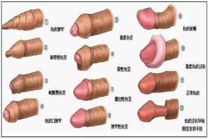 昌吉哪里做包皮手术便宜(昌吉男科医院排名最好的医院)